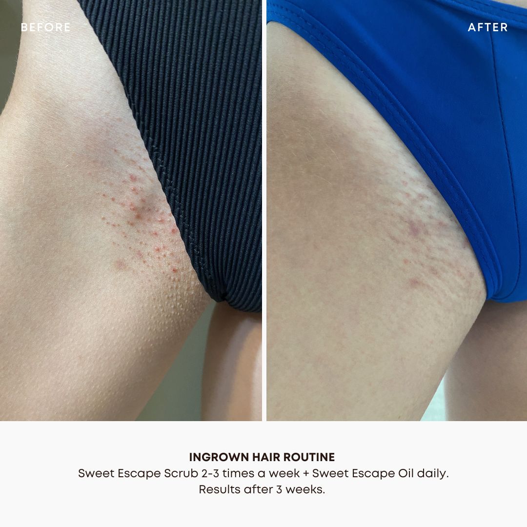 Sweet Escape Ingrown Hair 2 Step Routine - Image 4