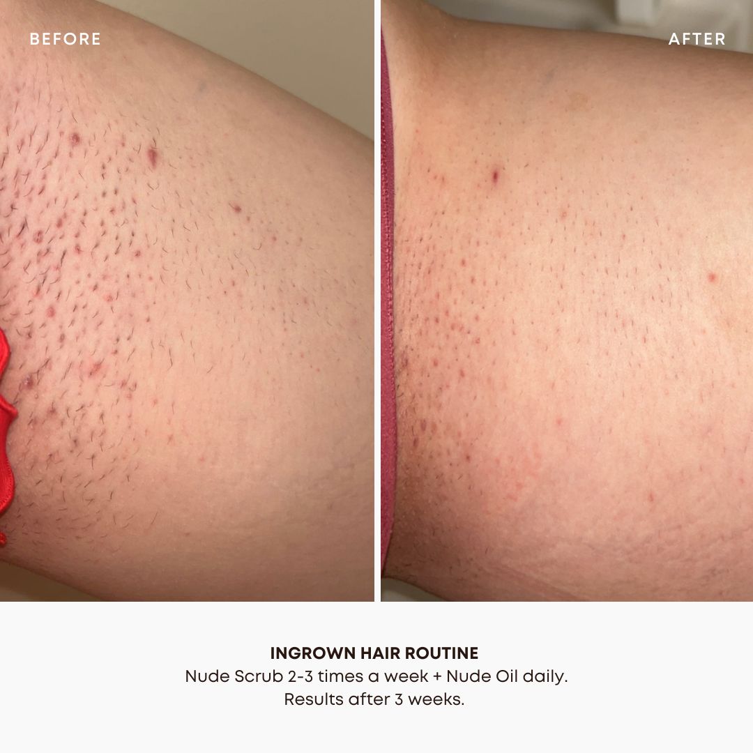 Nude Ingrown Hair Oil - Image 6
