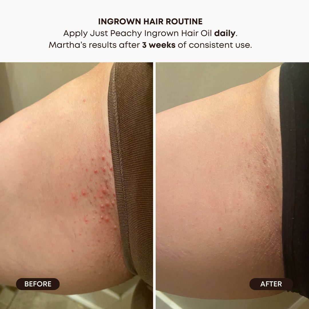 Watermelon Sugar Ingrown Hair 2 Step Routine - Image 4