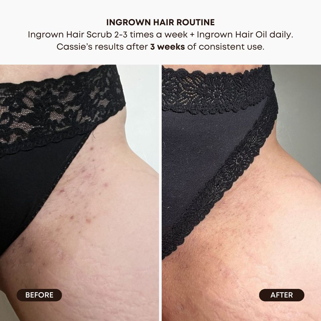 Watermelon Sugar Ingrown Hair Oil - Image 3